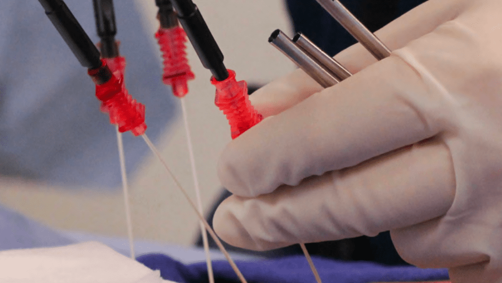 Radiofrequency Ablation: Innovative Treatment Options for Managing Nerve Pain